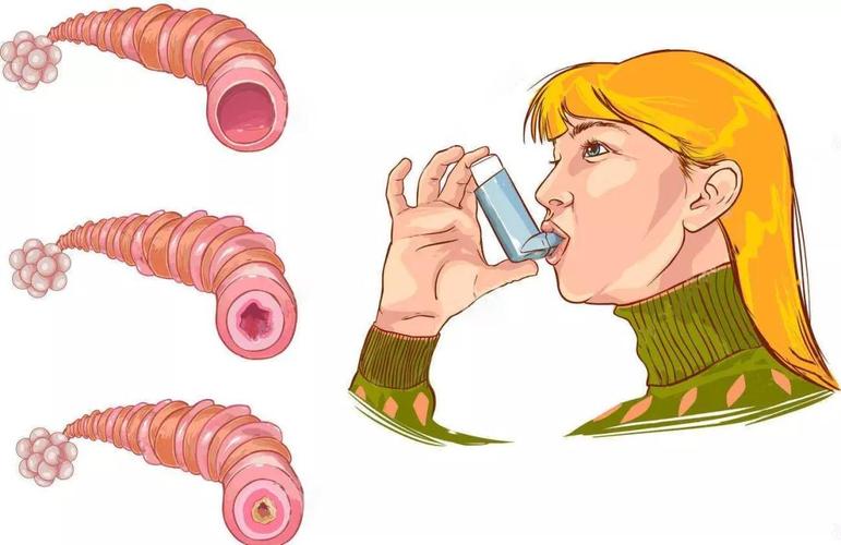 哮喘