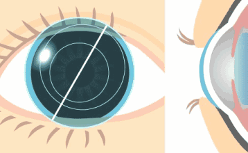 近视做飞秒手术有后遗症？做完近视手术一年视力模糊？