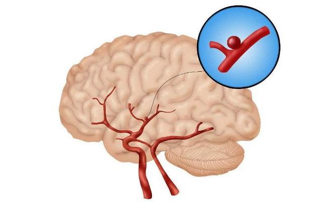 缺血缺氧性脑病是软灶化吗？