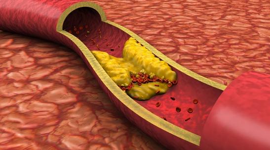 高胆固醇对人体的危害大吗？