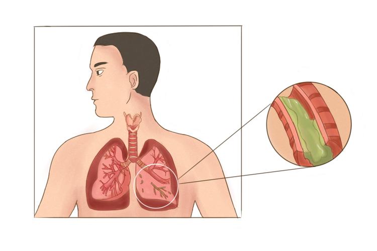 支气管扩张胸片影像表现