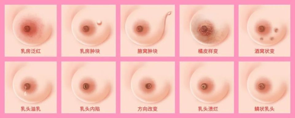 乳腺癌的具体症状
