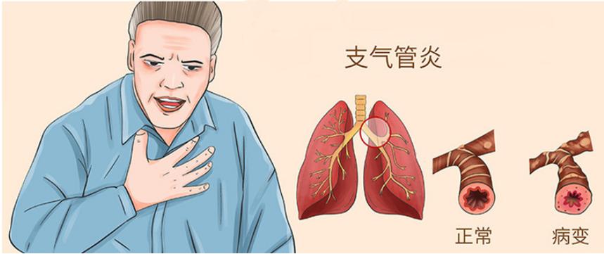 支气管炎肺部感染严重吗