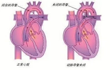 动脉导管未闭