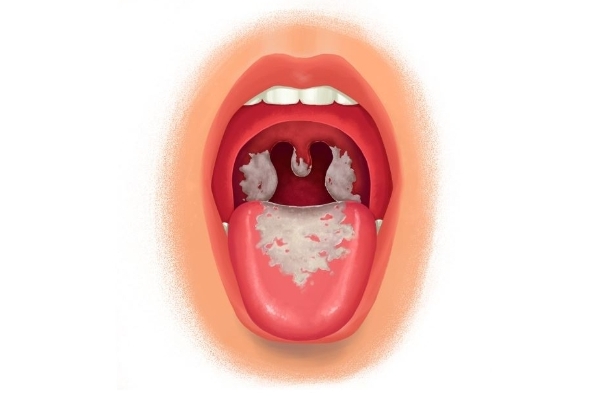 白喉病的症状和治疗
