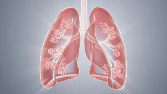 肺部感染怕的三个征兆