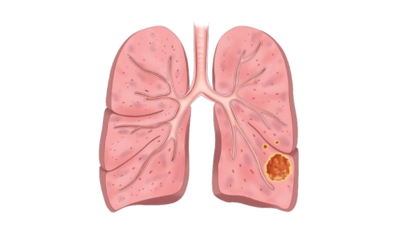 肺脓肿的主要病原体是革兰阳性细菌和革兰阴性细菌