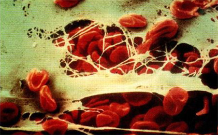 弥散性血管内凝血指的是，异常的血栓/纤维蛋白溶解