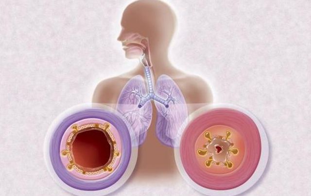 气管炎和支气管炎的区别，病变的部位不同临床表现存在差异