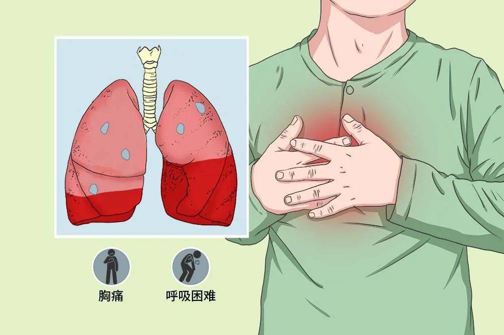 气胸的定义，气体进入胸腔而引起的疾病