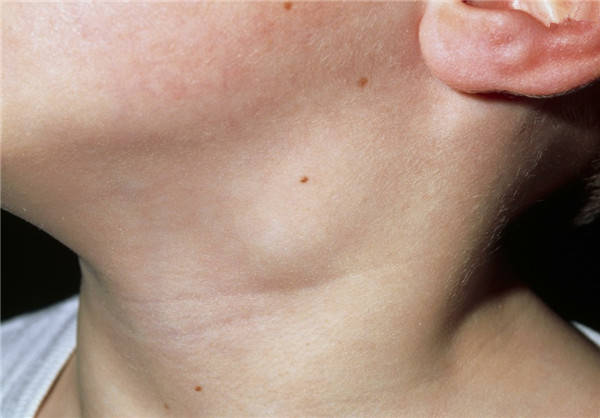 浅表淋巴结肿大是什么样子的，皮下浅表的淋巴结发生异常变大