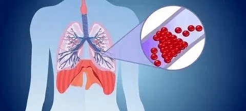 肺隔离症CT表现有哪些，肺动脉及其分支的扩张/肺动脉壁增厚
