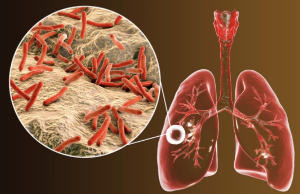 肺结核的主要传播途径是什么，通过空气飞沫传播