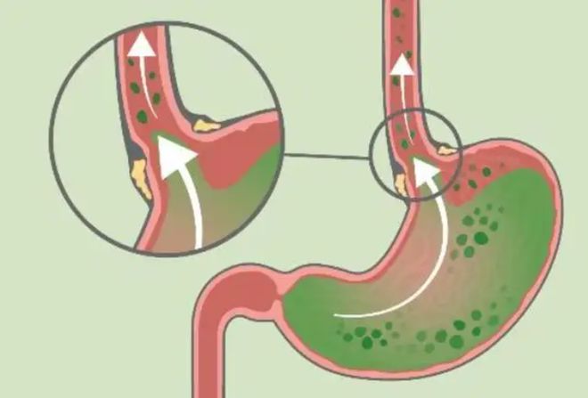 食管炎症状表现有哪些，吞咽困难/胸痛和酸反流