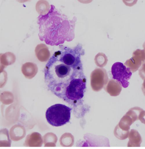噬血细胞综合征是白血病吗，不是(病因和症状都不同)