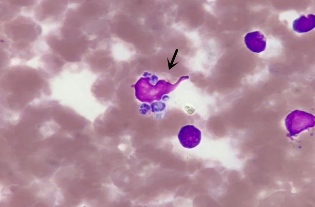 噬血细胞综合征