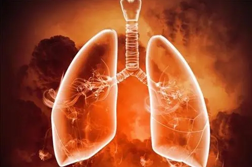 肺水肿是什么原因引起的(心脏病/肺部感染/肺血管疾病)