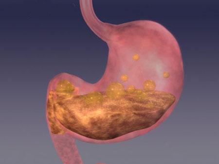 胃溃疡是什么原因导致的，细菌感染/长期使用抗炎药和不良生活习惯