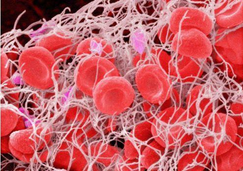 播散性血管内凝血概念，血管内出现凝血现象的一种血液疾病