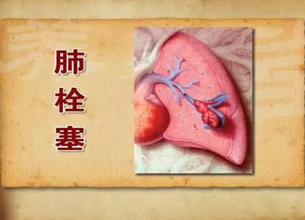 肺栓塞的早期症状和前兆，5个早期症状(胸痛/头晕)