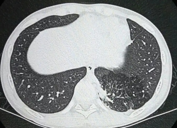 肺隔离症不手术会有什么肺隔离症，5种后果威胁到患者生命健康