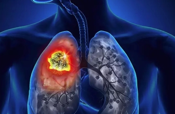 肺隔离症一般活多久，早期诊断和治疗是提高患者生存率的关键