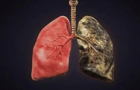 肺脓肿症状表现有哪些，有7种症状(咳嗽/发热/咳血)