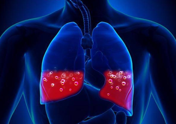 肺水肿是什么病严重吗，肺水肿的预防和治疗