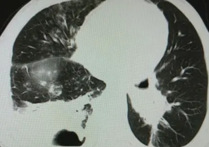 肺脓肿是什么病严重吗好不好治，治疗和预防是关键