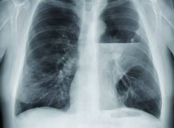 肺脓肿发病最多见的病因是，常见4类病因