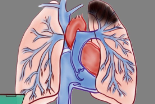 肺栓塞症状的表现和治疗方法，有5种症状(胸痛/晕厥)