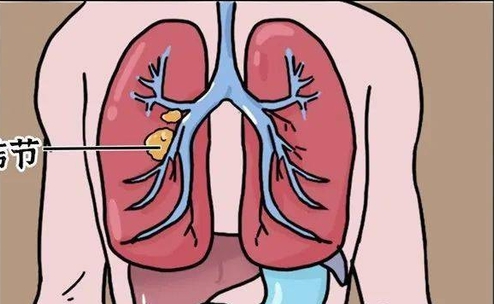 肺结节病是什么意思，肺部出现的小肿块(直径小于3厘米)