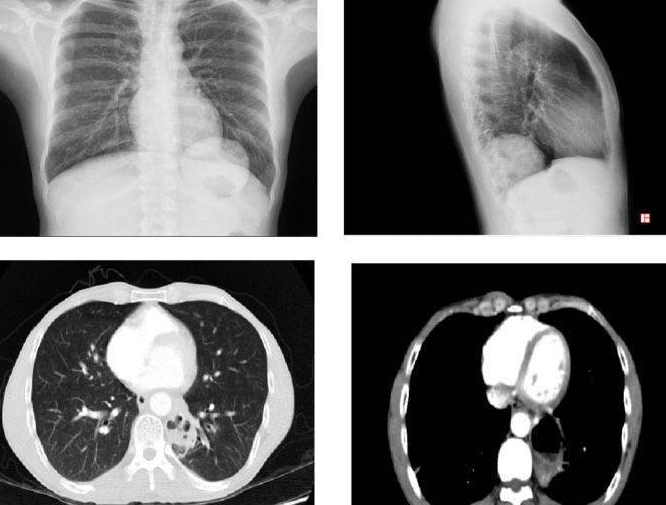 肺隔离症是怎么回事，肺组织发生异常分离现象