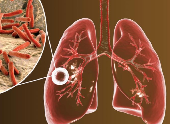 肺结核会传染吗，如何预防肺结核的传播