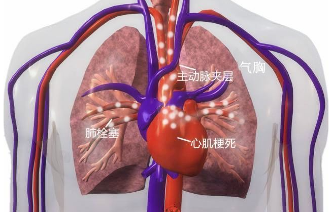 胸膜炎是什么病严重吗（呼吸系统疾病）