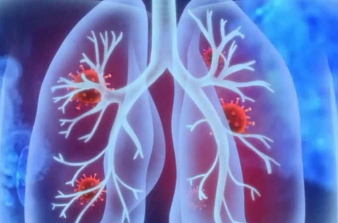 呼吸道感染的症状有哪些，常见6种症状(咳嗽/发热)