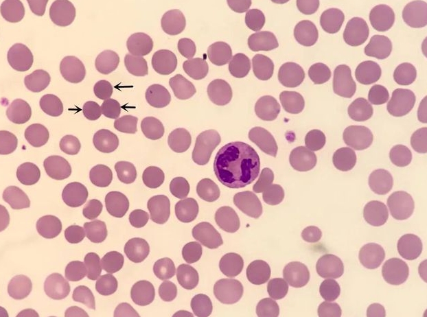 球形红细胞增多症和地中海贫血，都属于遗传性血液疾病