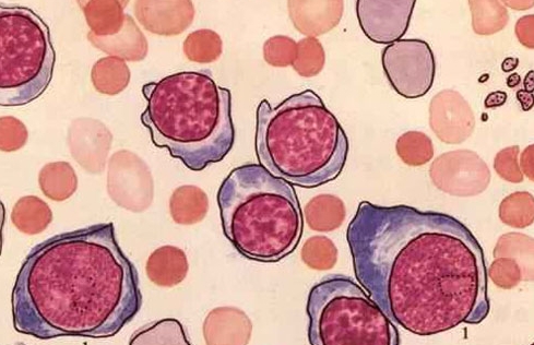 遗传性球形红细胞增多症红细胞渗透脆性(预防和治疗方法)