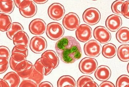 遗传性球形红细胞增多症能活多久，早期诊断和治疗是延长寿命的关键