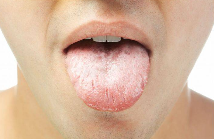 舌苔异样的原因（三大异常的主要表现）