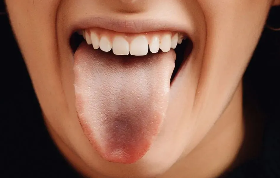 舌苔异常的症状有哪些症状（五种常见的异常症状）