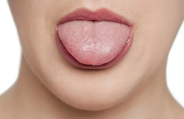 舌苔异味是怎么回事？不良习惯或身体健康问题所导致