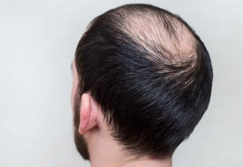 脂溢性脱发可以治愈吗？可通过适当的治疗方法得到缓解