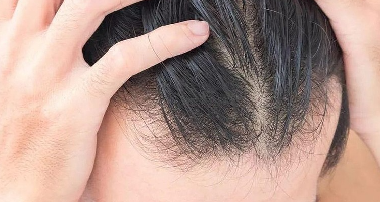 脂溢性脱发的原因？头皮细胞代谢异常，过多的油脂分泌