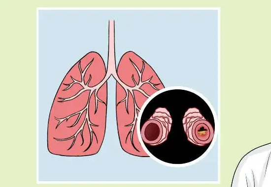 支气管扩张是什么原因引起的，常见原因有3种
