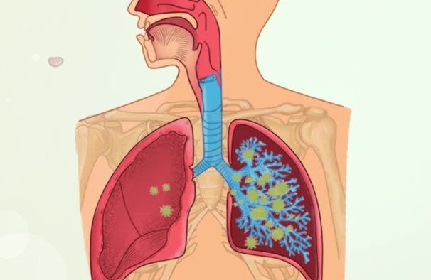 支气管结核和肺结核哪个严重，肺结核更严重