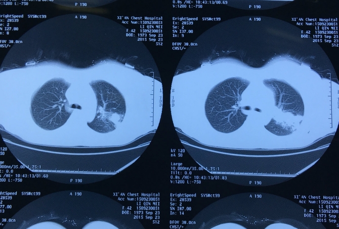 支气管肺隔离症CT表现，通过CT图像制定合理的治疗方案