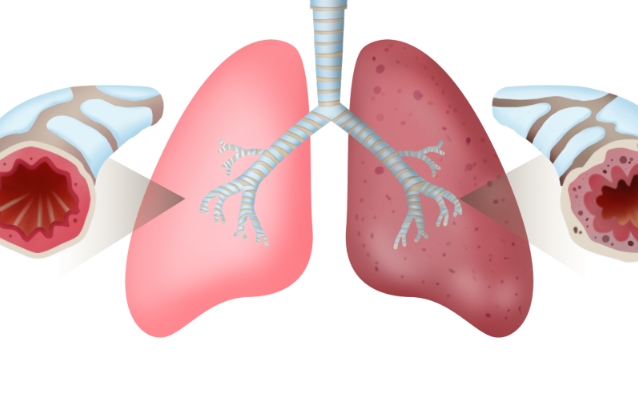 支气管肺隔离症严重吗，对特定高危人群是严重的