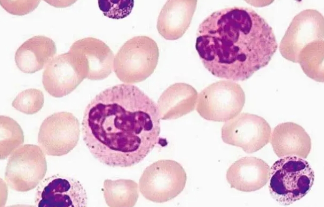 中性粒细胞减少症是白血病吗，不是(病症不同)