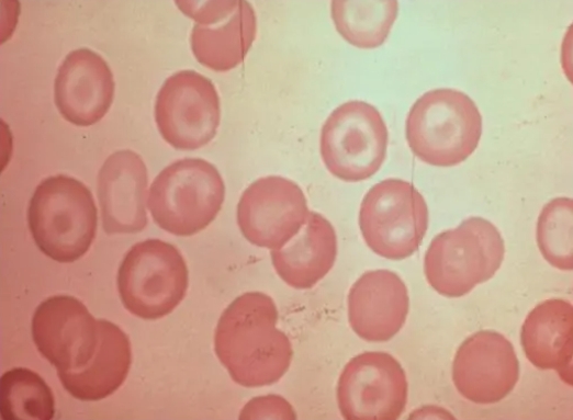遗传性椭圆形红细胞增多症的临床表现包括，有5种临床表现